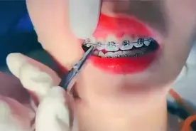 金属牙套拆换钢丝的过程，很多小伙伴好奇金属钢丝和托槽怎么拆换视频封面