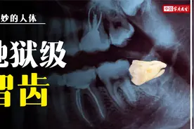 智齿忍着不拔，脸上竟烂了个洞？哪些智齿一定要拔？视频封面