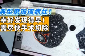 这个“蝴蝶状”的磨玻璃病灶，是一个早期肺癌，应尽早手术视频封面