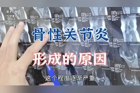 肖教授讲解骨性关节炎形成的原因，尽早发现或避免疾病的形成视频封面