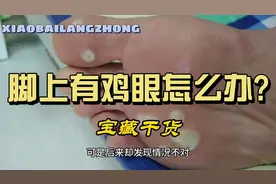脚上长了鸡眼、跖疣，反复发作，一定要试试这味中药视频封面