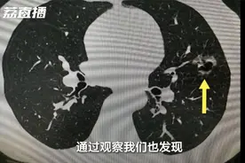 女子肺部莫名长了“巨大肿瘤” 竟是二手烟“惹的祸”视频封面