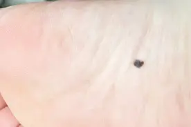 手上长黑色的“痦子”，是疾病的征兆吗？如果突然变大就要小心了视频封面