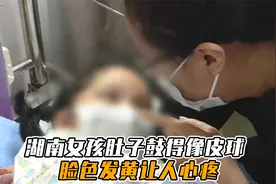 湖南女孩肚子鼓得像皮球，脸色发黄让人心疼，大夫接诊后揭开病因视频封面