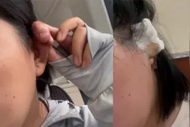 疤痕体质打耳洞要慎重！女子打耳洞8年后疤痕增生，需手术和放疗视频封面