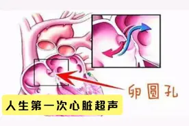 人生第一次心脏彩超，很多人都不正常！别怕！这不一定是心脏病视频封面