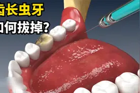 被虫牙支配有多痛苦？一分钟演示换牙过程，看完忍不住挤牙槽视频封面