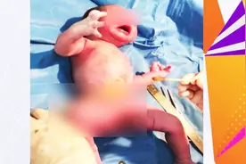 奇葩！产妇临盆竟不知自己怀孕！孕期减肥致婴儿先天畸形！视频封面