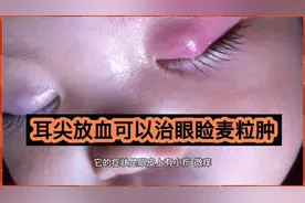 在耳尖上放血，可以治眼睑上的麦粒肿视频封面