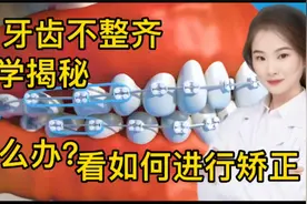 医学演绎 人体牙齿不整齐 龅牙 地包天 如何进行修复 牙套使用视频封面