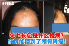 头上长包是什么怪病？你可能摸到了颅骨骨瘤！