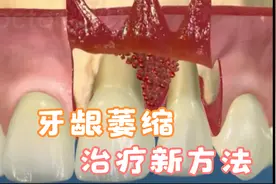 牙龈修复手术视频，牙龈萎缩不可怕，分享一种新型治疗方法手术视频封面