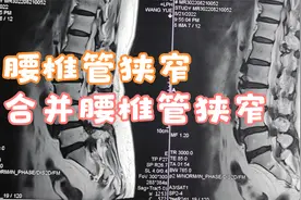 行走不到200米双下肢酸胀、疼痛和麻木，需蹲下休息2分钟，啥情况视频封面