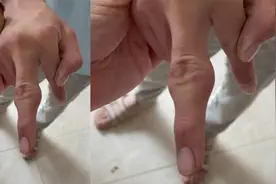 父母在外打工，重庆14岁学生长期喝奶茶吃垃圾食品，手指严重变形视频封面