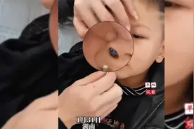 男孩调皮把玻璃弹珠弄进鼻孔里，妈妈用挖耳勺尝试几次都没挖出视频封面
