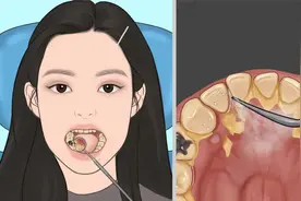 美女口腔得了牙结石，第一视角看医生如何清理，视频解压又下饭视频封面