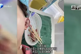 爱美人士请注意！女子打耳洞致右耳坏死，医生：很难恢复如初视频封面