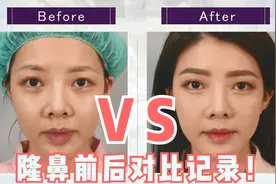 记录耳软骨隆鼻恢复过程，术后痛到崩溃，做鼻子居然还改善了凸嘴视频封面