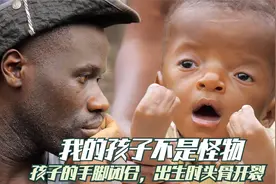 因为长相怪异，我的孩子被称为邪物，他真的只是一个普通的孩子视频封面