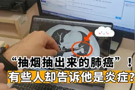 一天三包烟！“老烟民”查出肺结节，有人怀疑炎症我却判断肿瘤视频封面