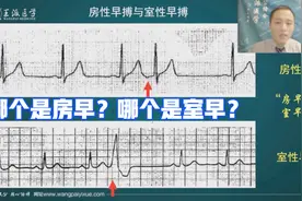 通过一幅心电图，专家教你怎么区分房性早搏和室性早搏？视频封面