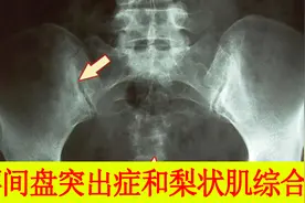 梨状肌综合症和腰椎间盘突出症，不要傻傻分不清视频封面