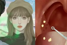 美女口腔散发恶臭味，第一视角看医生清理口腔结石，全程解压下饭视频封面