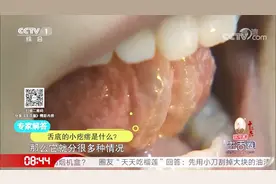 舌底的小疙瘩要注意，质地比较硬就要注意啦，有可能是囊肿视频封面