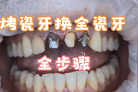 科普烤瓷牙拆除步骤：不想做金属烤瓷牙原因就是核磁共振需要拆除视频封面