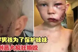 6岁男孩为了保护妹妹，遭到恶犬疯狂撕咬，送到医院脸上缝了90针视频封面