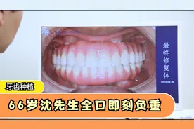 种植牙案例：66岁沈先生烤瓷牙用了10年，拔掉后全口即刻负重视频封面