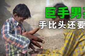 从未见过如此之大的手，竟有43cm长，手比头还大，巨手男孩纪录片视频封面