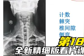 全新精细版看片课程第18集:颈椎影像读片，MR，CT，X光的详细讲解视频封面