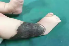 女婴腿上长颗痣！家长没在意！三月后竟然吃掉了半条腿视频封面