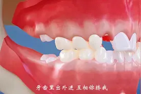 牙齿拥挤不齐 小虎牙不在其位，该怎么办？视频封面