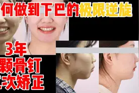 高角骨性前突、门牙歪斜，如何解决第一次矫正时留下的大难题？视频封面