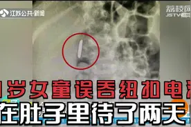 淮安：1岁女童误吞纽扣电池，在肚子里待了两天！万幸未泄漏视频封面