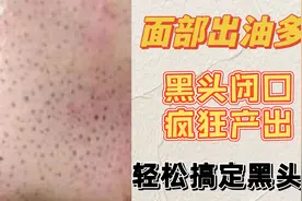 黑头疯长能不能挤？长期不清理黑头危害多！教你轻松去黑头！视频封面