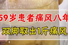 59岁患者痛风八年，双脚取出1斤痛风石视频封面
