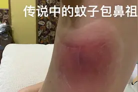女子被咬碗口大蚊子包花千元治疗：觉得很离谱视频封面