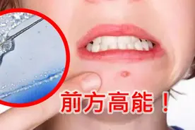 粉刺挤出的白色液体是啥？显微镜下一看，让我省了一顿饭视频封面