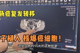 结肠癌复发转移,无手术机会,30颗粒子植入后,肿块消失!三天出院!视频封面