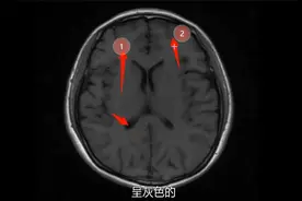 颅脑核磁常用序列识别方法视频封面