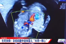 孕妇腹中怀有连体婴，俩娃“共用一颗心”，专家：排畸检查很重要视频封面