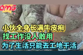 小伙全身长满牛皮癣，找工作没人敢用，为了生活只能去工地干活视频封面