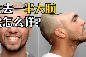 如果人类失去一半大脑，会发生什么？“无脑症”又是什么？