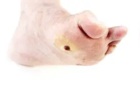 糖尿病足溃烂，最关键的是控制血糖，另外3件事也不容忽略！视频封面