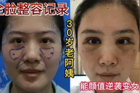 30岁老阿姨全脸整容记录，眼综合面部填充手术，30天后颜值逆袭视频封面