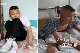 第一次手术后，张波的嘴和身体分开了大约30度，已经能自己吃饭啦视频封面