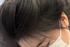 太神了！脱发秃头竟然只用3招解决，秃头逆袭发量王者不是梦！视频封面